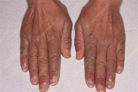 Acrocyanosis - Stock Image - C056/6578 - Science Photo Library