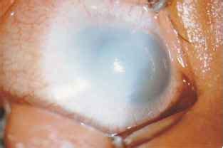 Sclerocornea - Optic Nerve - GUWS Medical