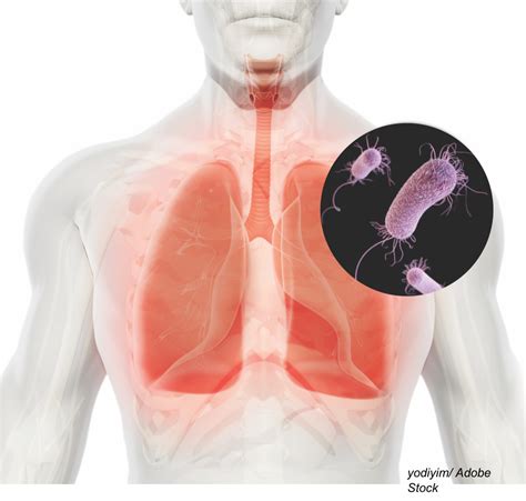 Hospital-Acquired and Ventilator-Associated Pneumonia: Highlights and Pitfalls of the 2016 IDSA ...