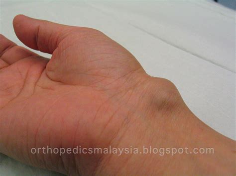 GANGLION CYST - swelling in the wrist | The Orthopedics Malaysia blog