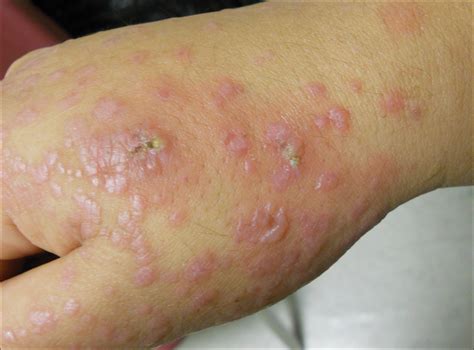 Dermatitis During Pregnancy