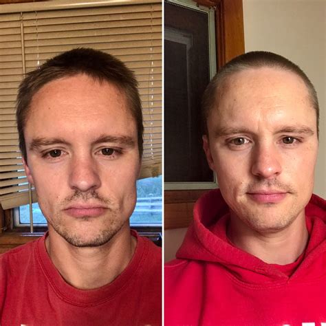 3 Months Carnivore Diet Before and After Picture – Diet & holistic health – Acne.org Forum