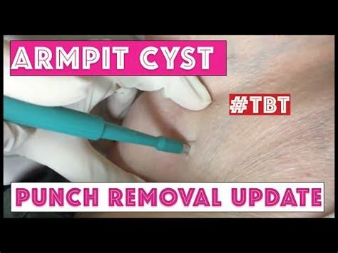 A cyst removed by punch biopsy tool, 6 months later: TBT in 2020 | Armpit cyst, Epidermoid cyst ...