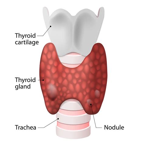 Thyroid Nodules