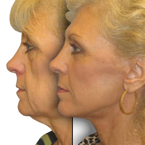 Cheek Lift in Beverly Hills, CA | Dr. Jason Diamond