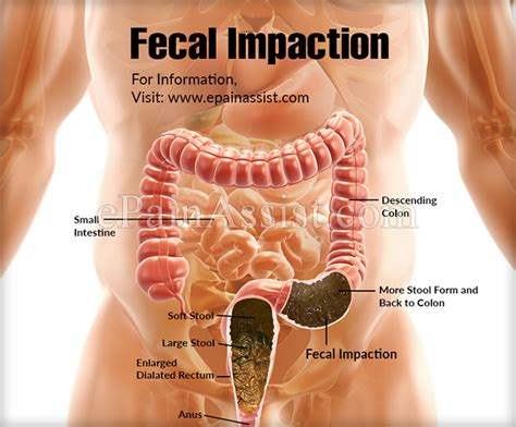 Colonics for Fecal Impaction – Colonic Irrigation Colon Hydrotherapy ...