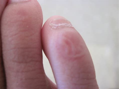 How to Treat Blisters and Deal With Recovery | RemedyGrove