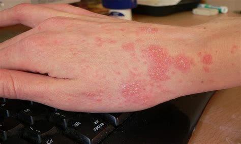 Rashes That Look Like Scabies Causes Symptoms And Treatment | Images and Photos finder