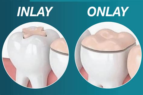 Incrustaciones estéticas (inlay onlay) – Dra Juana Ochoa