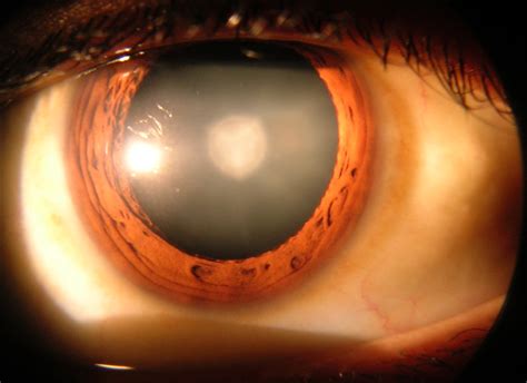 Intumescent Cataract: Signs, Impacts and Treatment Options