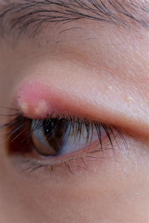 Stye Eye Diseases