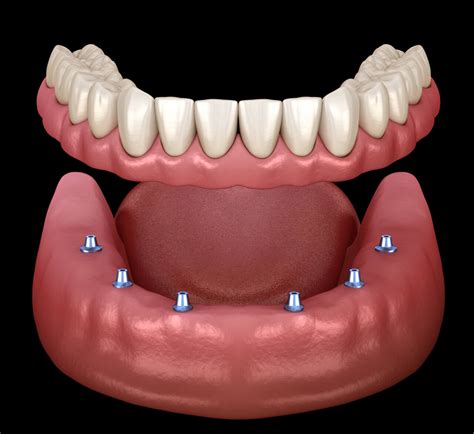 Dental Implant Supported Dentures