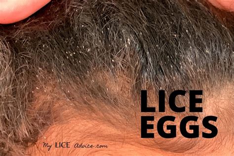 Biggest head lice ever found - lomilogin