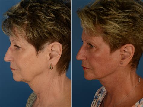 The UpLift™ Lower Face and Neck Lift Photos | Naples, FL | Patient 14461