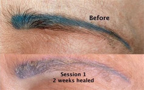 saline eyebrow tattoo removal before and after - lineartdrawingspeoplesketch