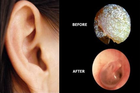 Unclog Your Ears Naturally! Here’s How To Do It! | Ear wax removal, Remedies, Natural remedies