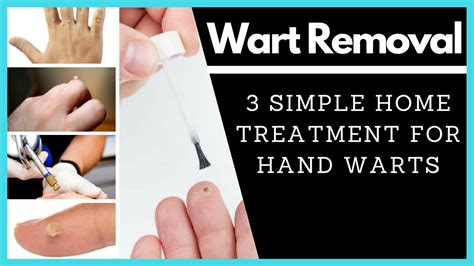 3 Simple Home Treatments For Hand Warts (2018) | Home treatment, Wart on finger, Warts