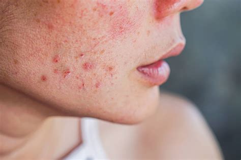 Menopause acne: causes and treatment