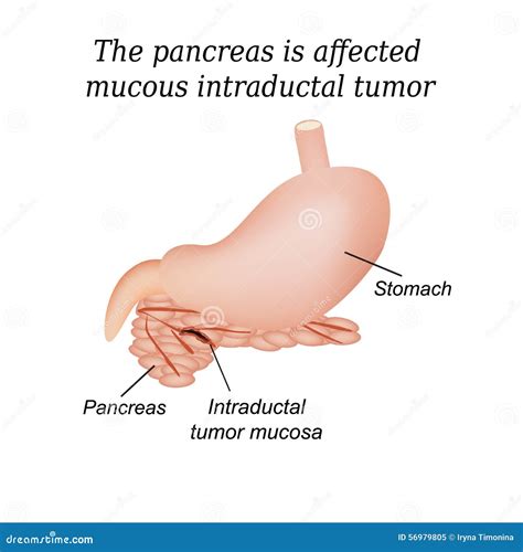 The Pancreas is Affected Mucous Intraductal Tumor Stock Vector - Illustration of internal ...