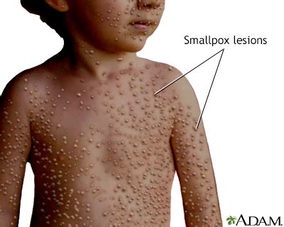 Smallpox Information | Mount Sinai - New York