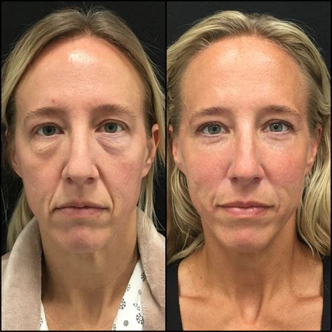 Lower Blepharoplasty Before & After Photos | Flora Levin MD