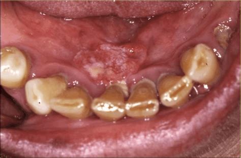 What Causes Floor Of Mouth Cancer | Viewfloor.co