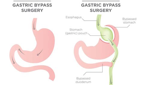 Duodenal Switch Complications - Bariatric Journal