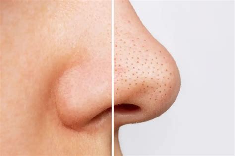 Guide to Blackheads: Causes, Prevention and Removal Techniques | Acne Talks