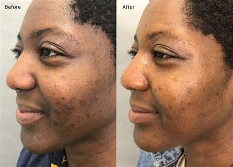 Microneedling for Hyperpigmentation: Efficacy, Side Effects, and More