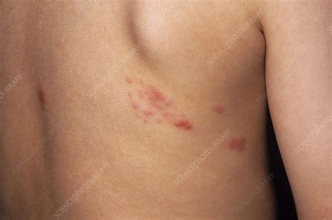 Shingles rash - Stock Image - M260/0293 - Science Photo Library