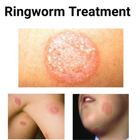 Ringworm Home Treatment: Discover The Secret To Remove Ringworm ...