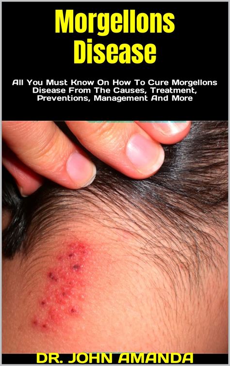 Morgellons Disease : All You Must Know On How To Cure Morgellons ...