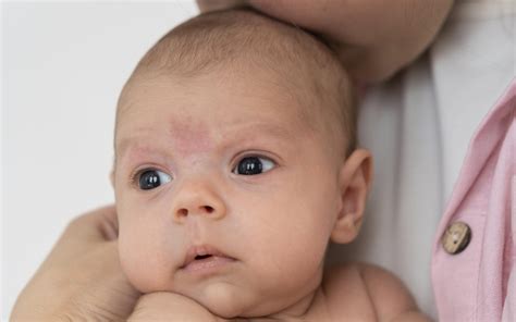 Baby acne causes and treatments - Infant Guides