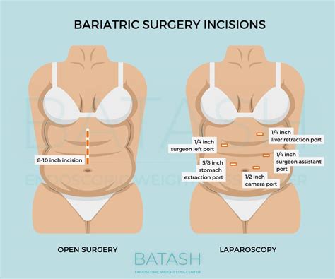 Bariatric Surgery Scars: Where and What Scars Will I Have?