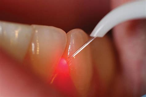 laser teeth whitening procedure video