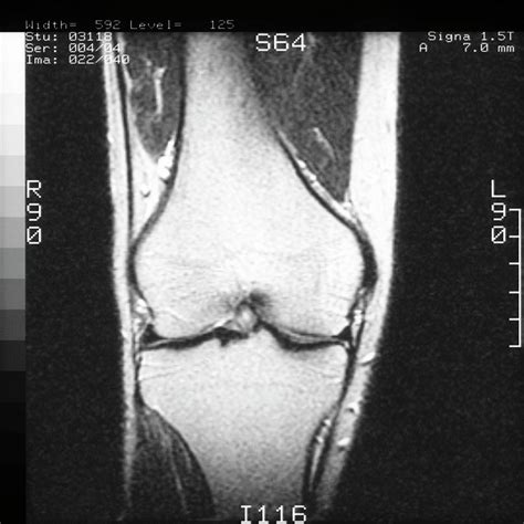 Mri Scan Of Coronal Section Through Knee Joint Photograph by Science ...