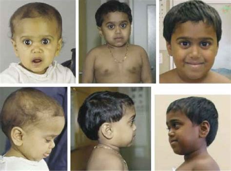 Laron syndrome causes, symptoms, diagnosis, treatment & prognosis