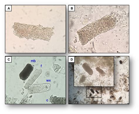 Urine Sediment of the Month: Granular & "Muddy Brown" Casts - Renal Fellow Network