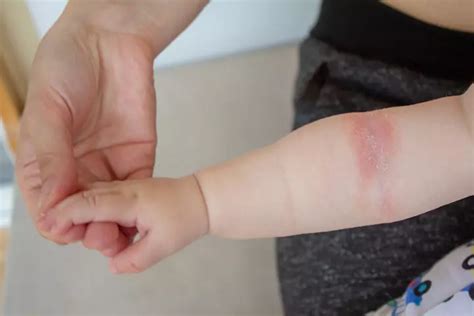 Baby Heat Rash: Causes, Diagnosis And Home Treatment