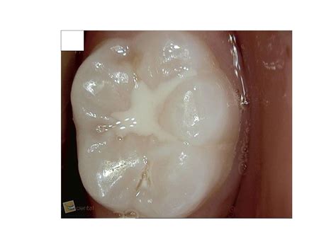 A comprehensive guide to dental sealants, with information on the sealant procedure, ... and ...