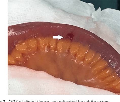 Figure 2 from A rare case of small bowel arteriovenous malformation ...