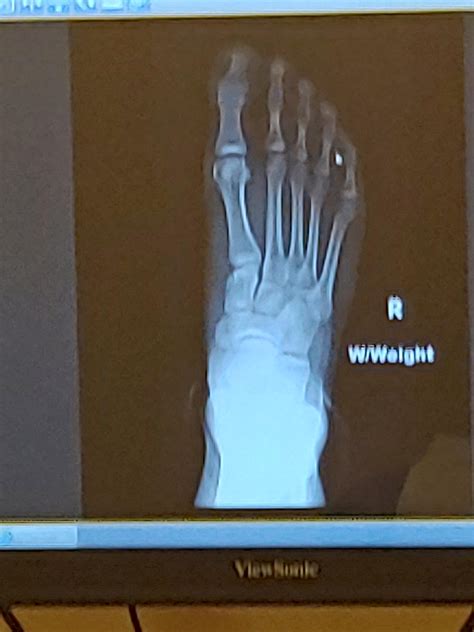 My foot : r/xrays