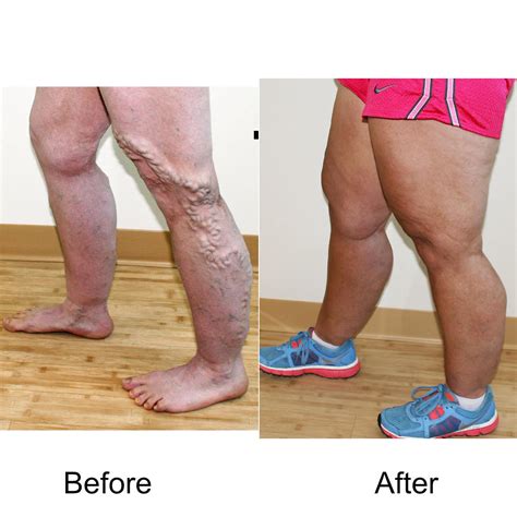 Varicose Veins Treatment in Waunakee, WI | Madison Medispa