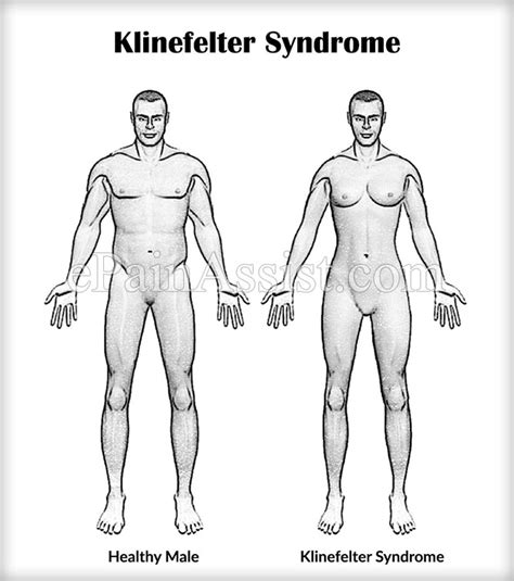 Klinefelter Syndrome|Causes|Symptoms|Treatment|Diagnosis