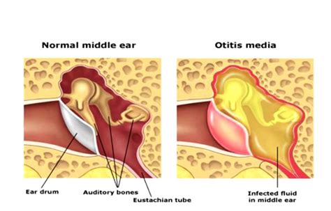 Ear Infection | Causes, Symptoms and Treatment