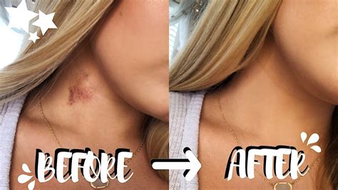 How To Get Rid Of Hickeys In Two EASY Steps! (no color correcting) | Brooklyn Anne - YouTube