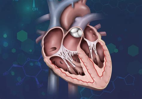 SGLT2 Inhibitor Use in Case of Acute Decompensated Heart Failure