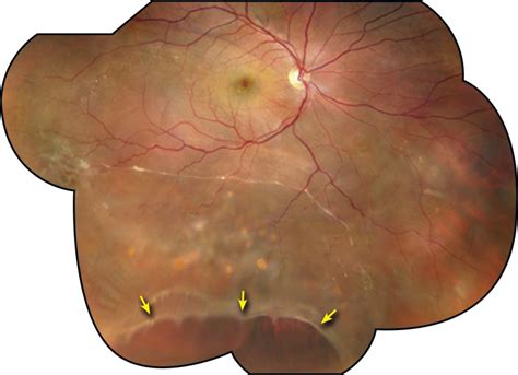 Operculated Retinal Hole In Retinal Detachment Retina