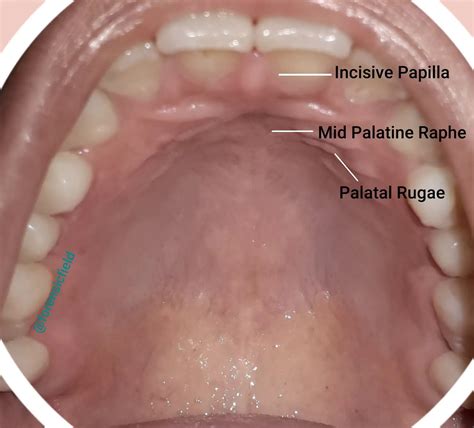 Palatal Rugae - Forensic's blog