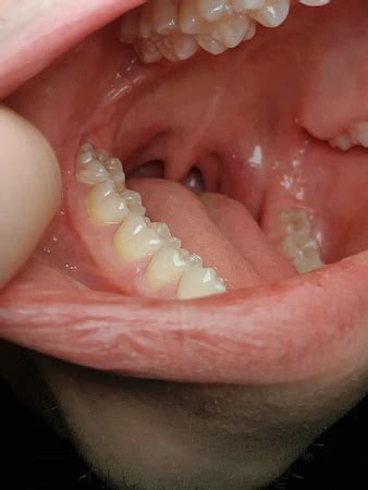 Stomatitis | Definition, Causes & Treatment | Study.com